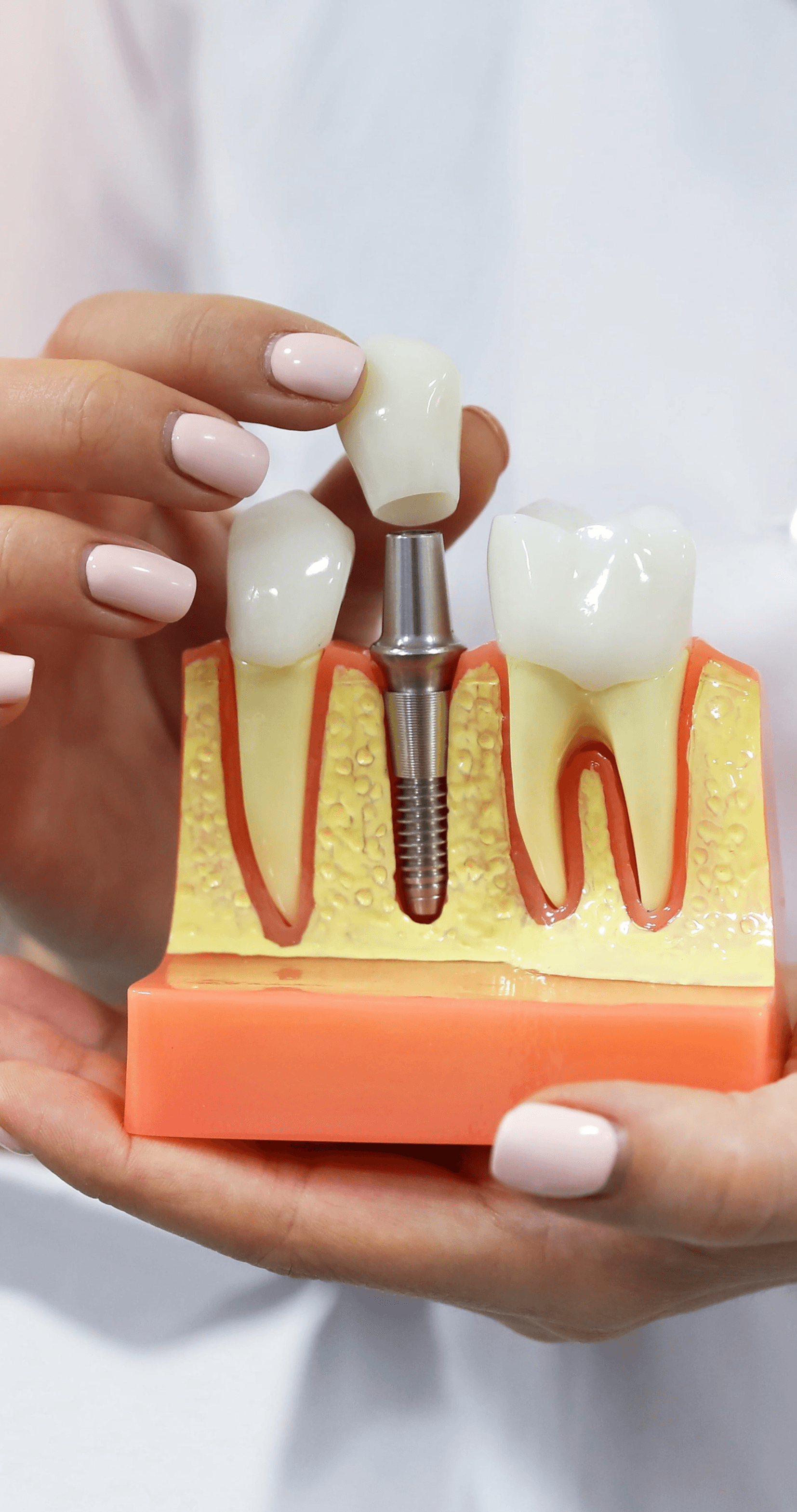 dental implants benefits at Dezy