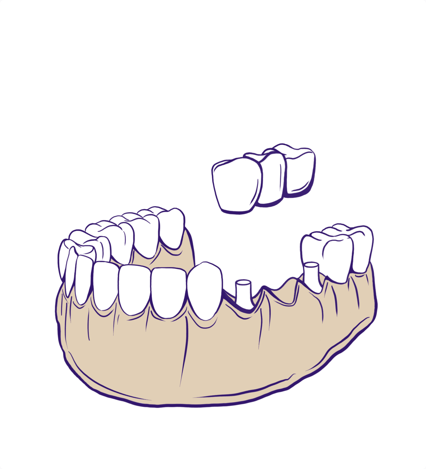 Dental Bridges